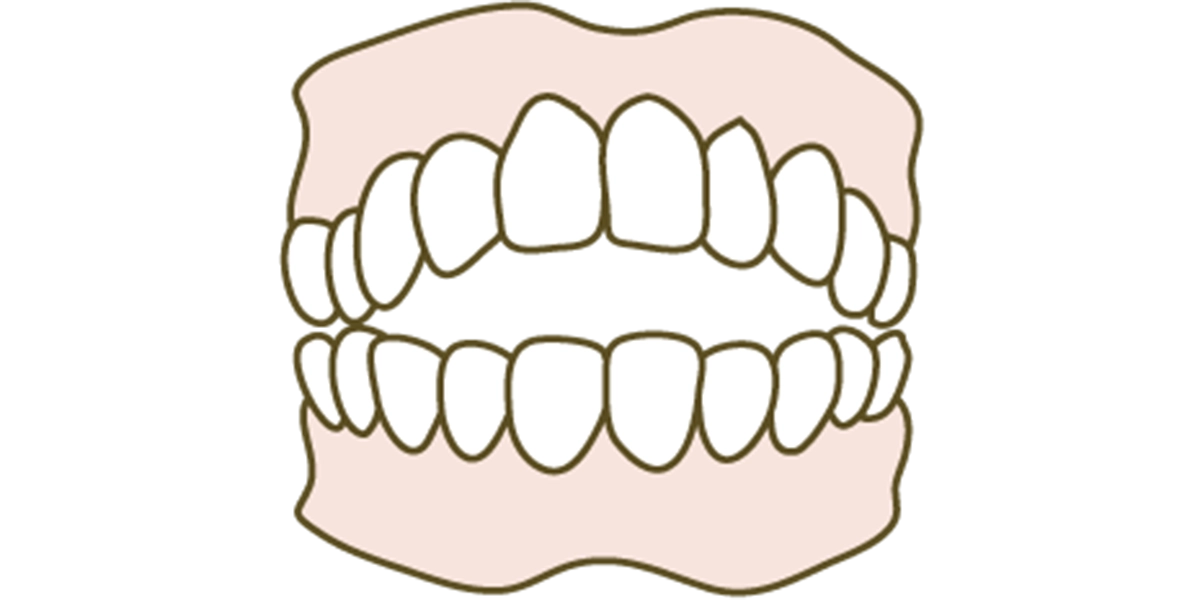 開咬(オープンバイト)