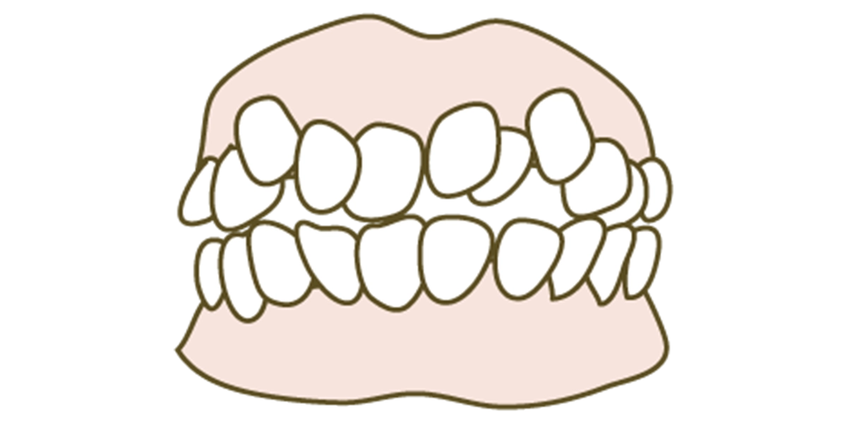 叢生(ガタつき)