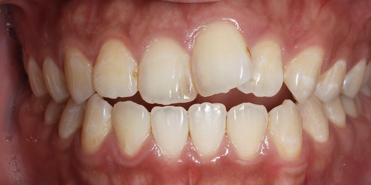 前歯が噛み合わない「開咬」と歯のガタつきをマウスピースで改善した例