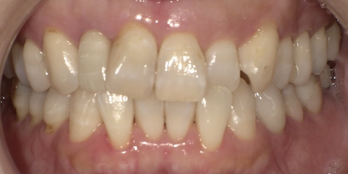 前歯のガタつき（叢生）を部分矯正で短期間に改善した例