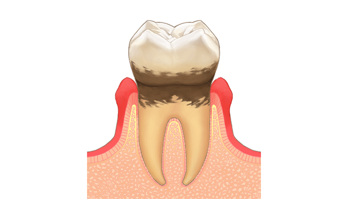 軽度歯周炎