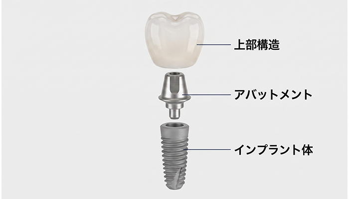 インプラント保証内容